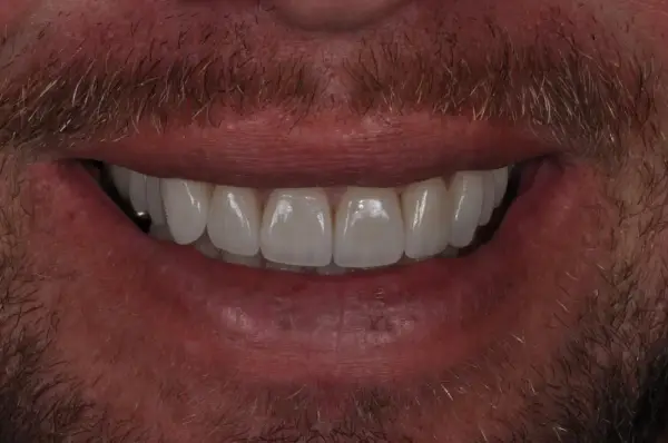 After — Upper Arch Porcelain Veneers