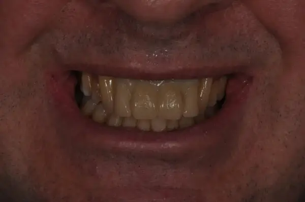 Before — Porcelain Veneer Smile Makeover