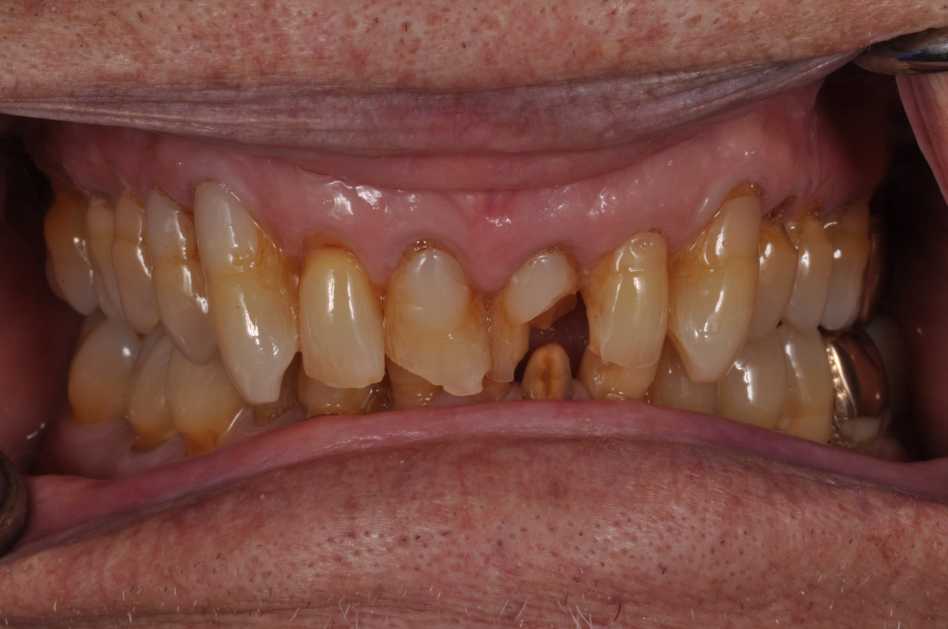 Before — Maxillary Full Arch Restoration