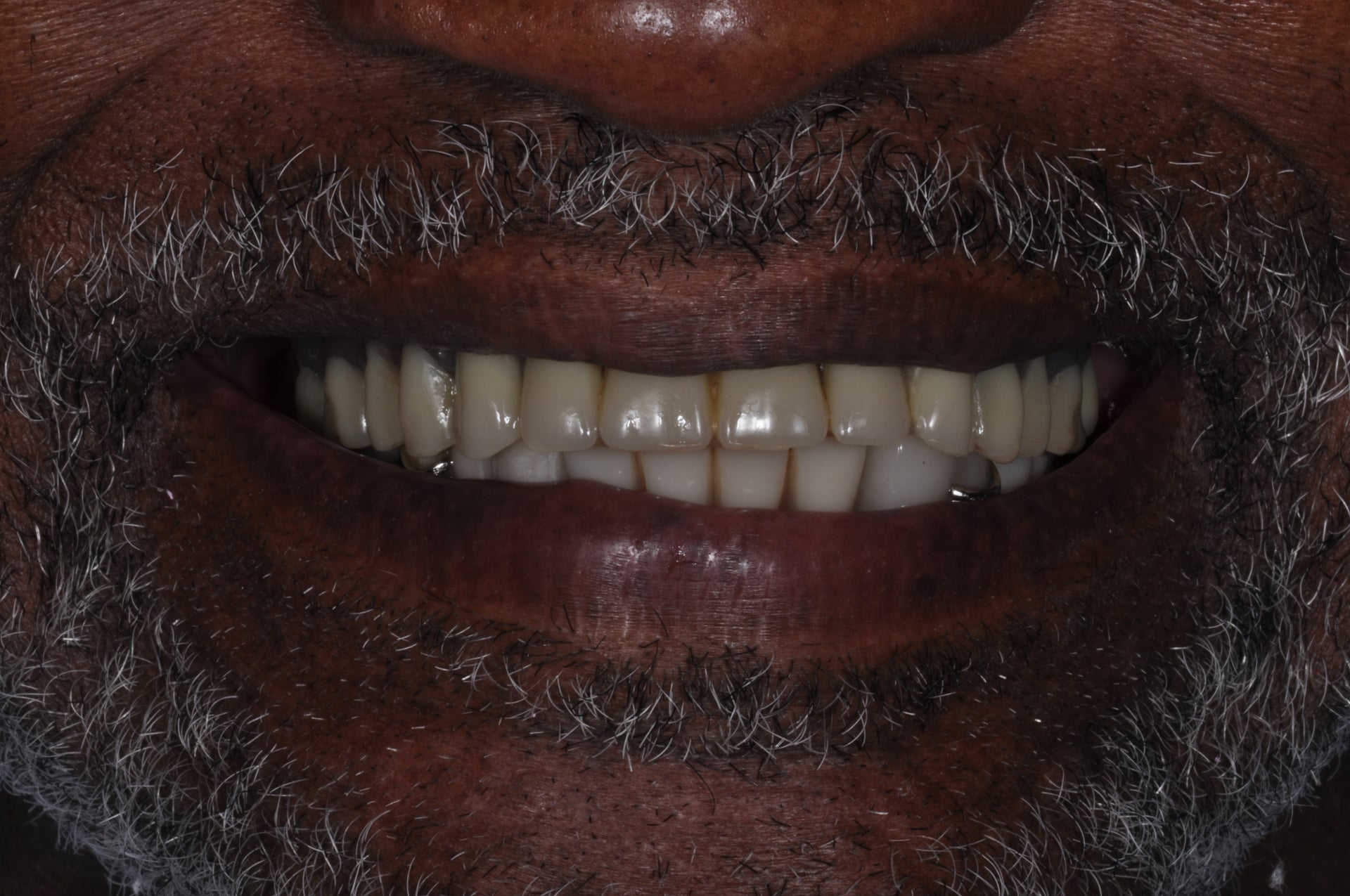 Before — Porcelain Veneer Smile Makeover