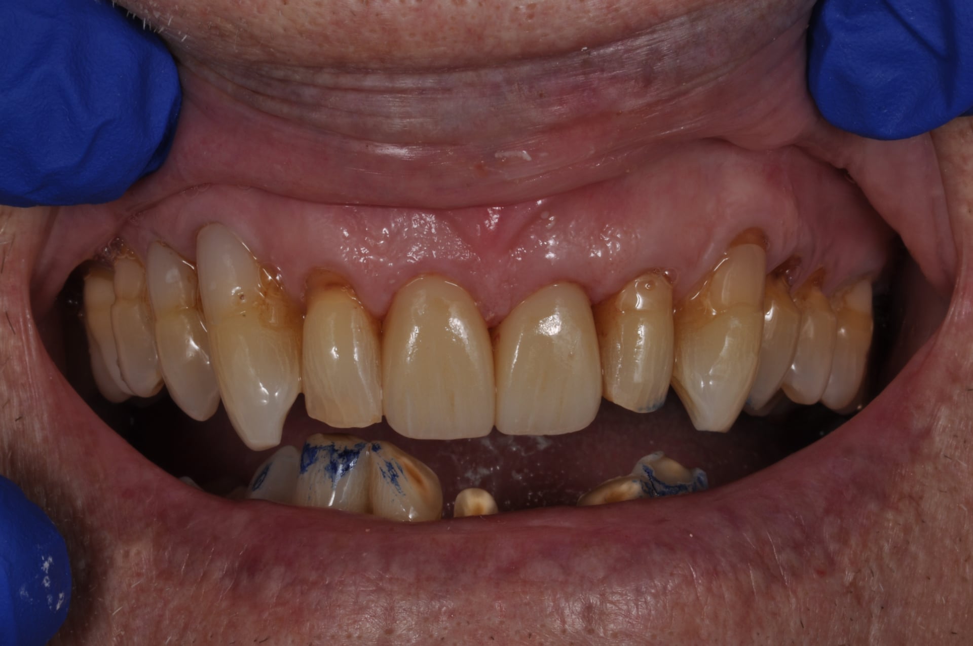 After — Maxillary Full Arch Restoration