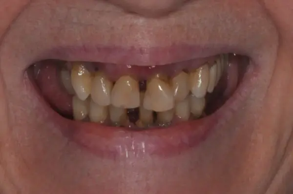 Before — Custom Complete Denture Smile Restoration