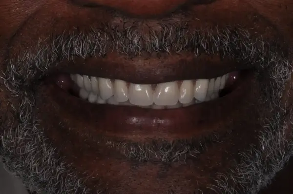 After — Porcelain Veneer Smile Makeover