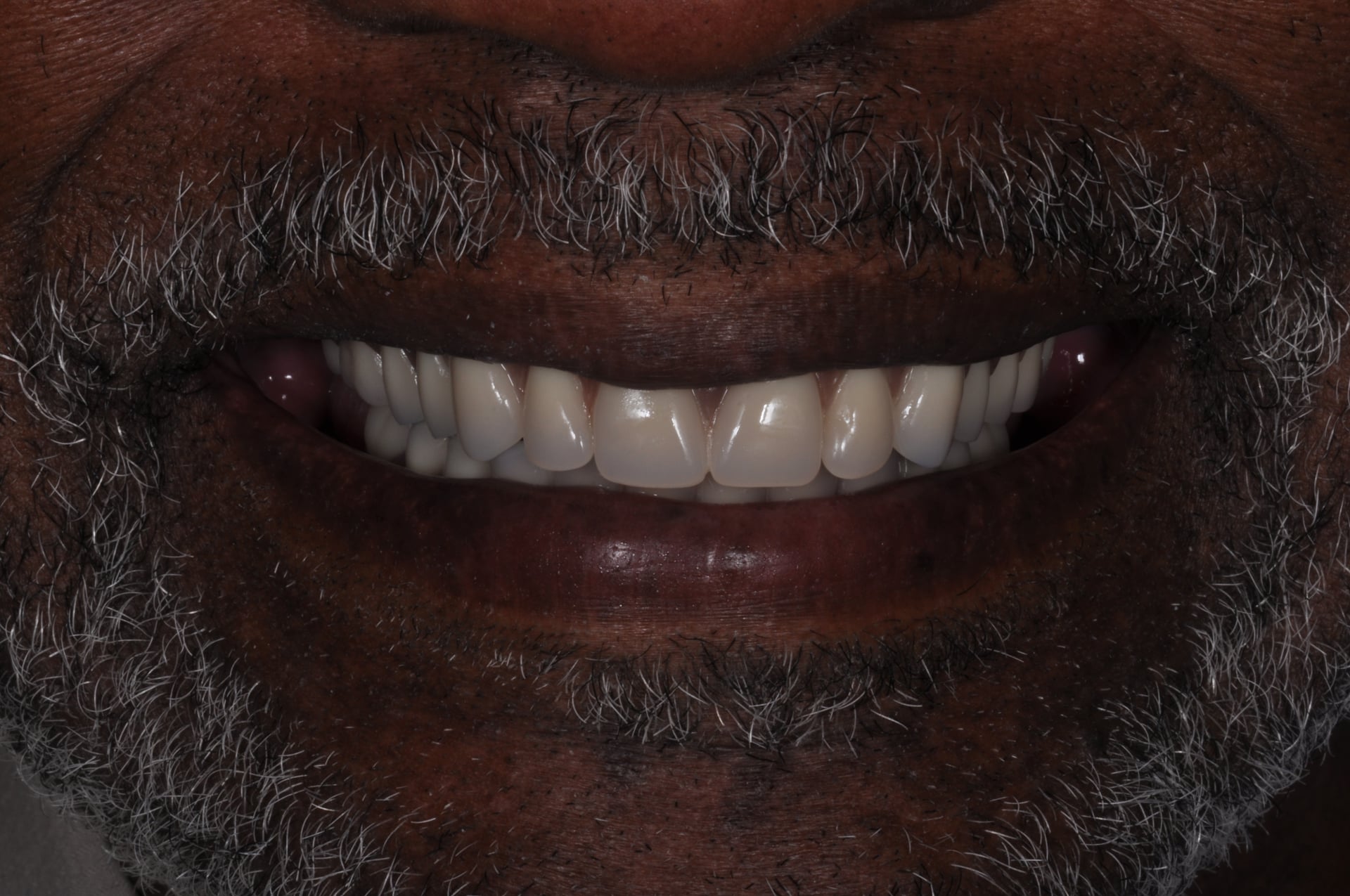 After — Porcelain Veneer Smile Makeover