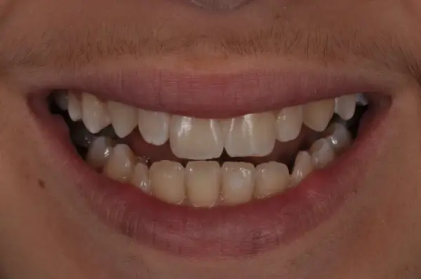 After — Chipped Tooth Cosmetic Bonding