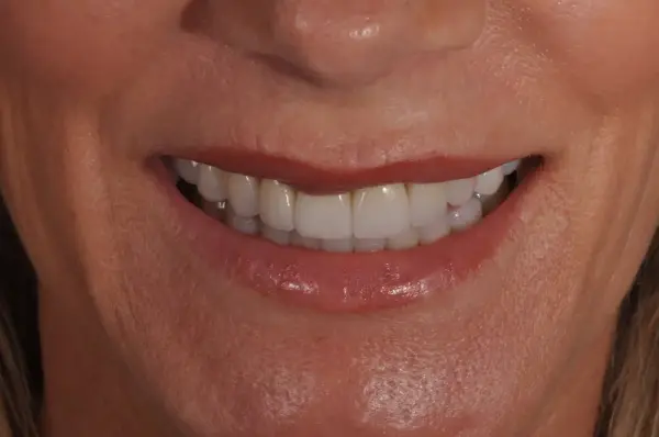 After — Porcelain Veneer Smile Makeover