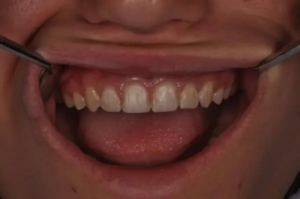 Before — White Spot Cosmetic Treatment