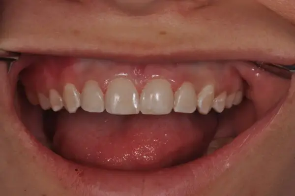 After — White Spot Cosmetic Treatment
