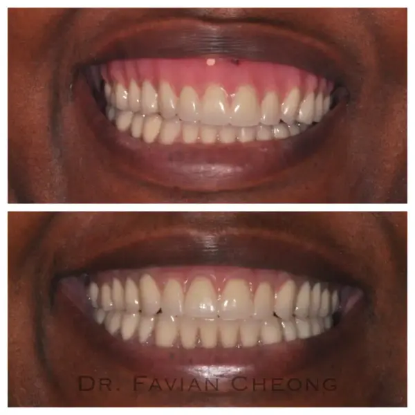 Result — Complete Denture Smile Transformation