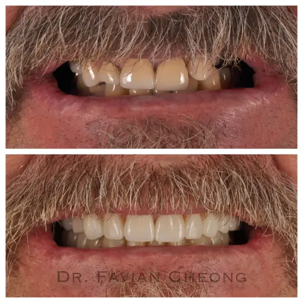 Result — Full Arch Before and After